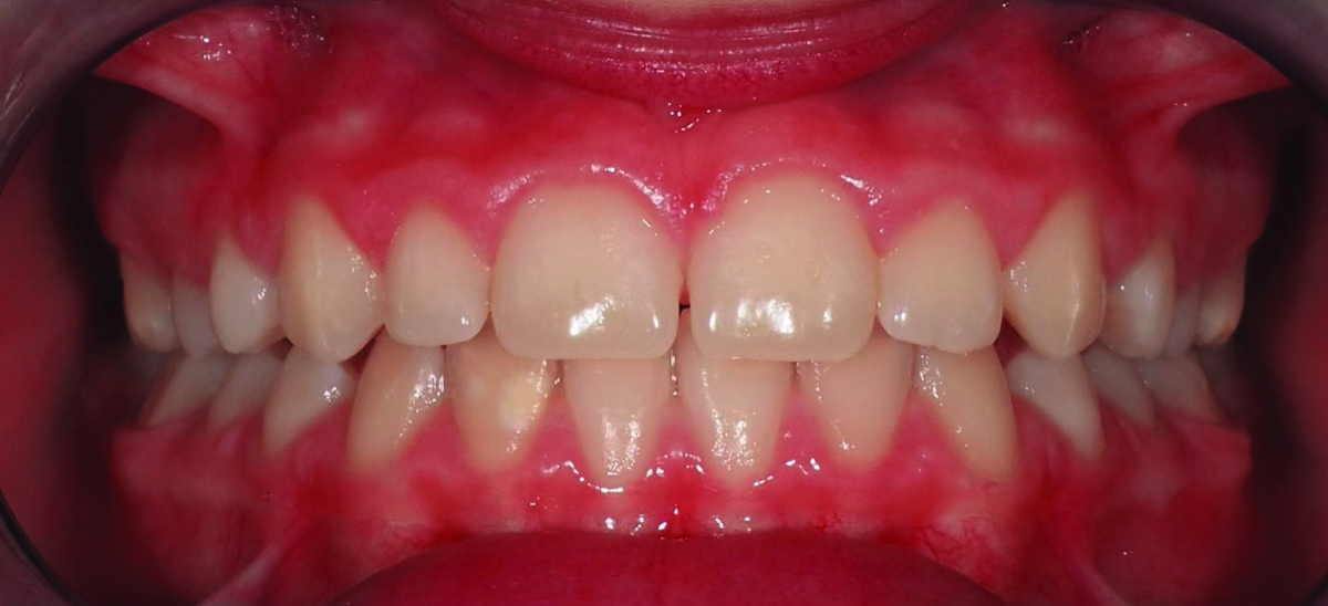 Dopo – Diastema interincisivo superiore in bambina di 7 anni