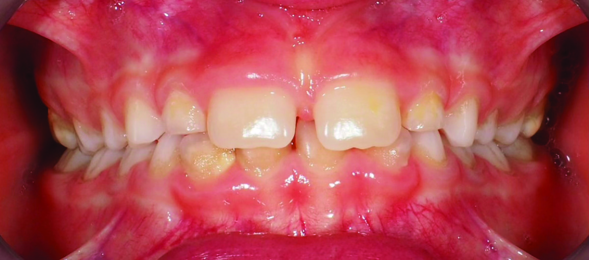Prima – Diastema interincisivo superiore in bambina di 7 anni
