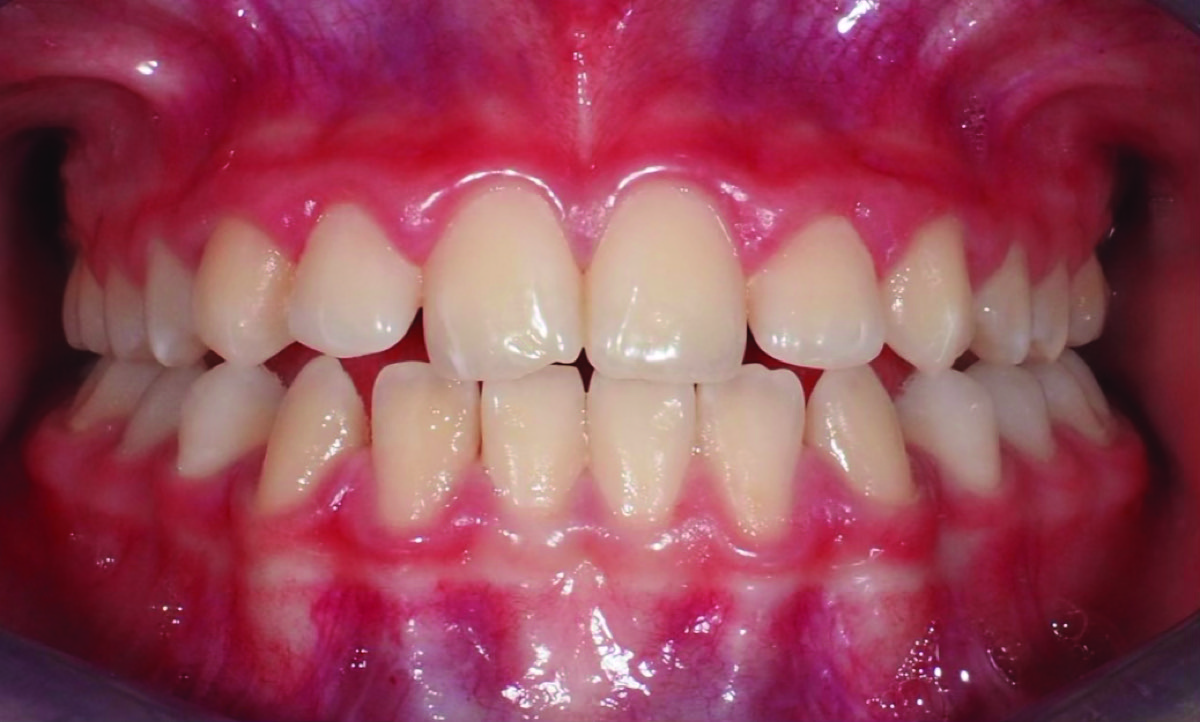 Dopo – Affollamento dentale in dentizione mista: bambina 8 anni