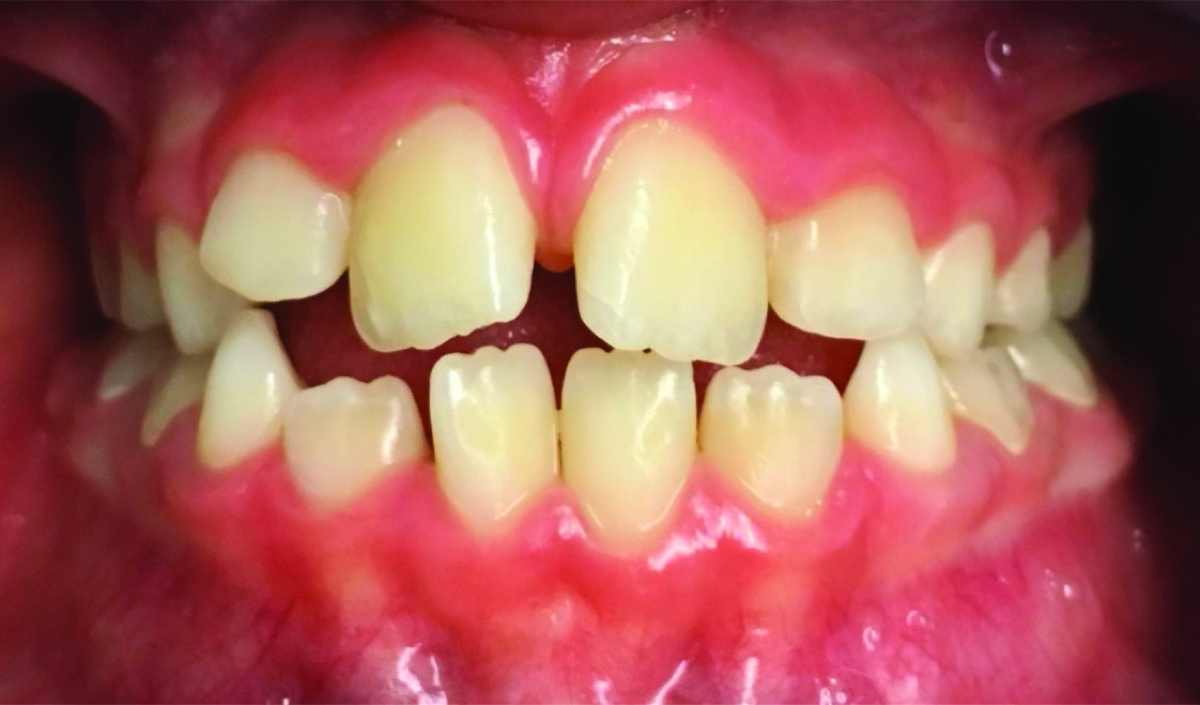 Prima – Affollamento dentale in dentizione mista: bambina 8 anni